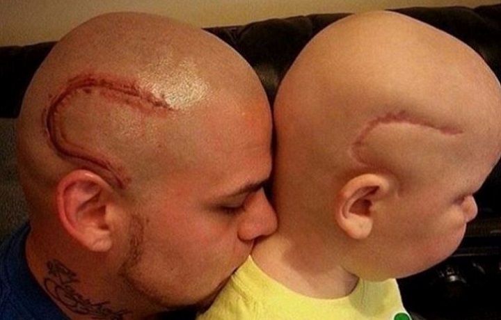 Si tatua una cicatrice sulle testa: il motivo è commovente
