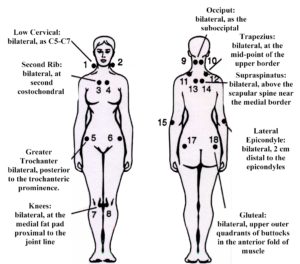 Methods of treating fibromyalgia