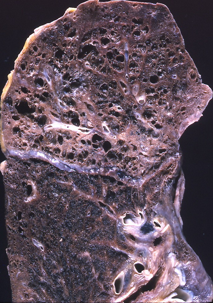 COPD Life Expectancy- What You Need to Know