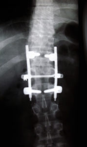 Risks of Lower back surgery