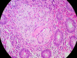 What to Include or Exclude in a Colitis Diet Menu