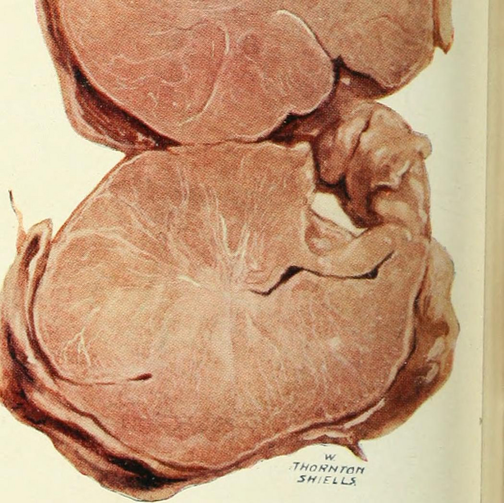 How To Treat Fibroids - Tips that Work