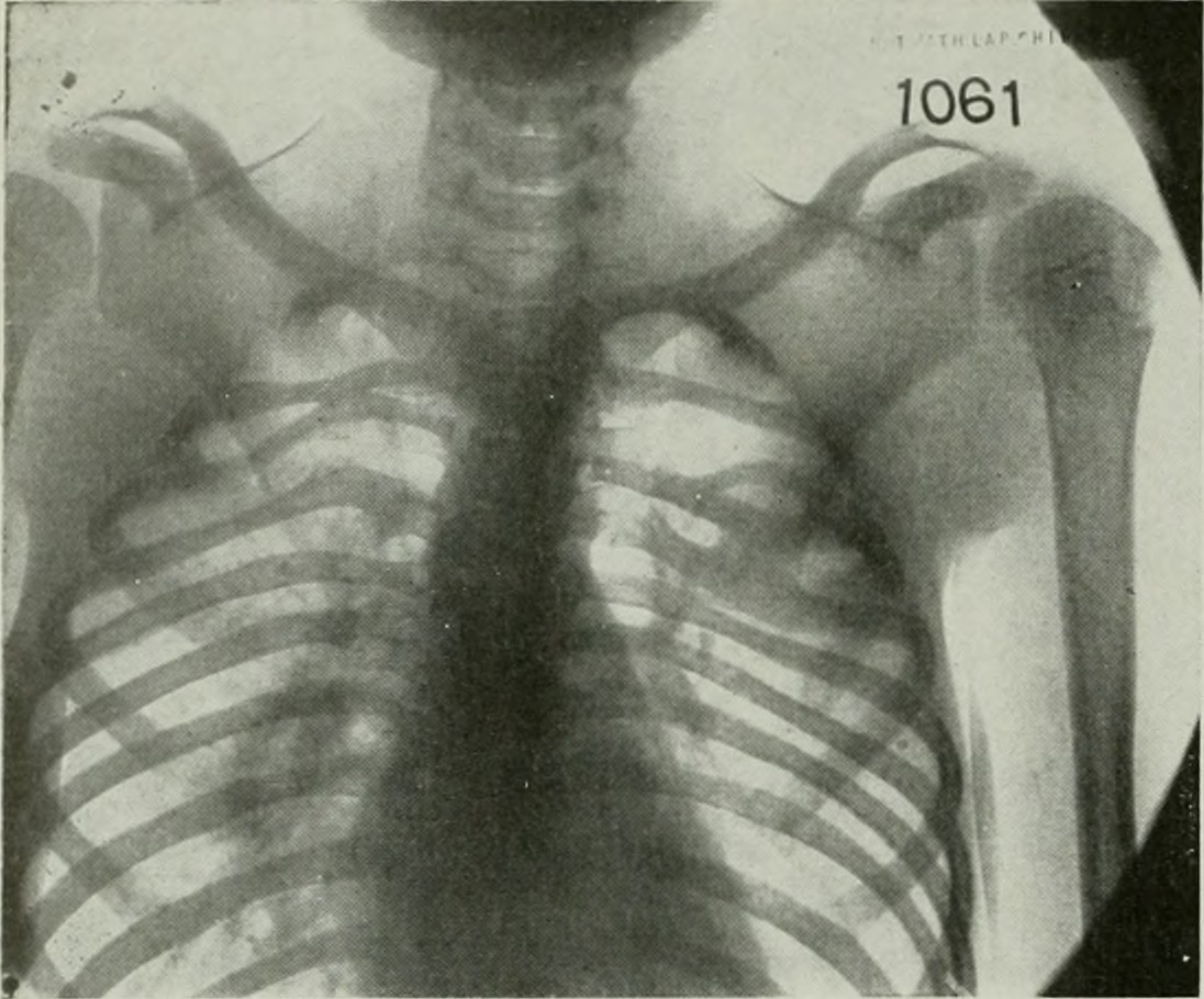 Why is Neck Fusion Procedure required?