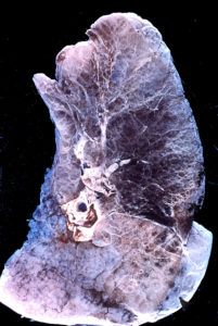 Popular Emphysema Treatment Options