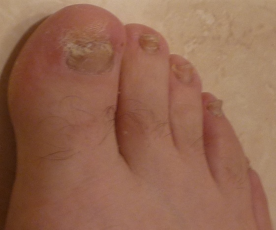 Simple Toe Nail Fungus Cure