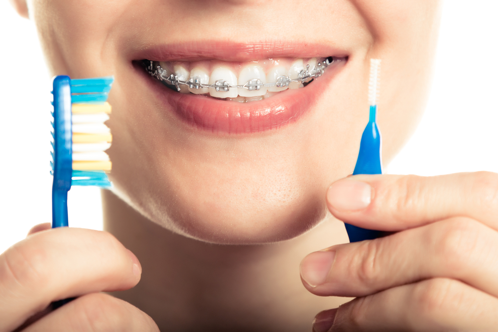 How to Keep Dental Braces Clean