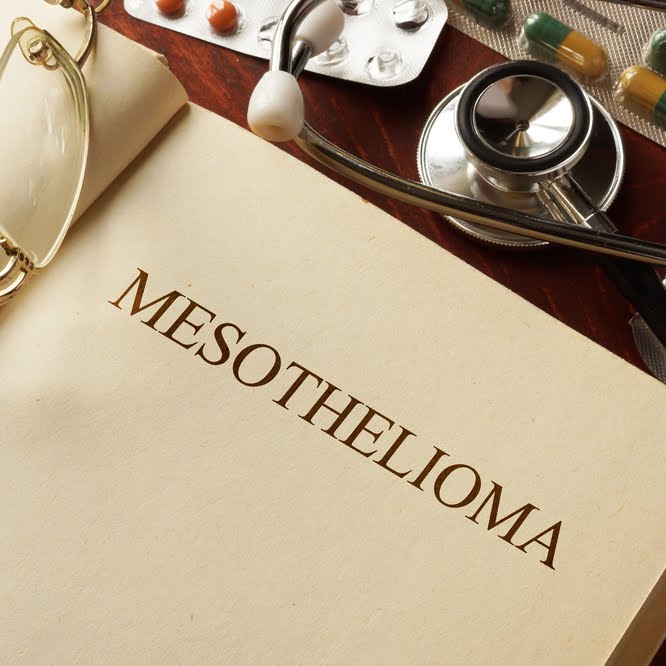 Search For Mesothelioma Doctor